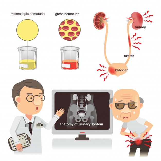 hematuria-causas